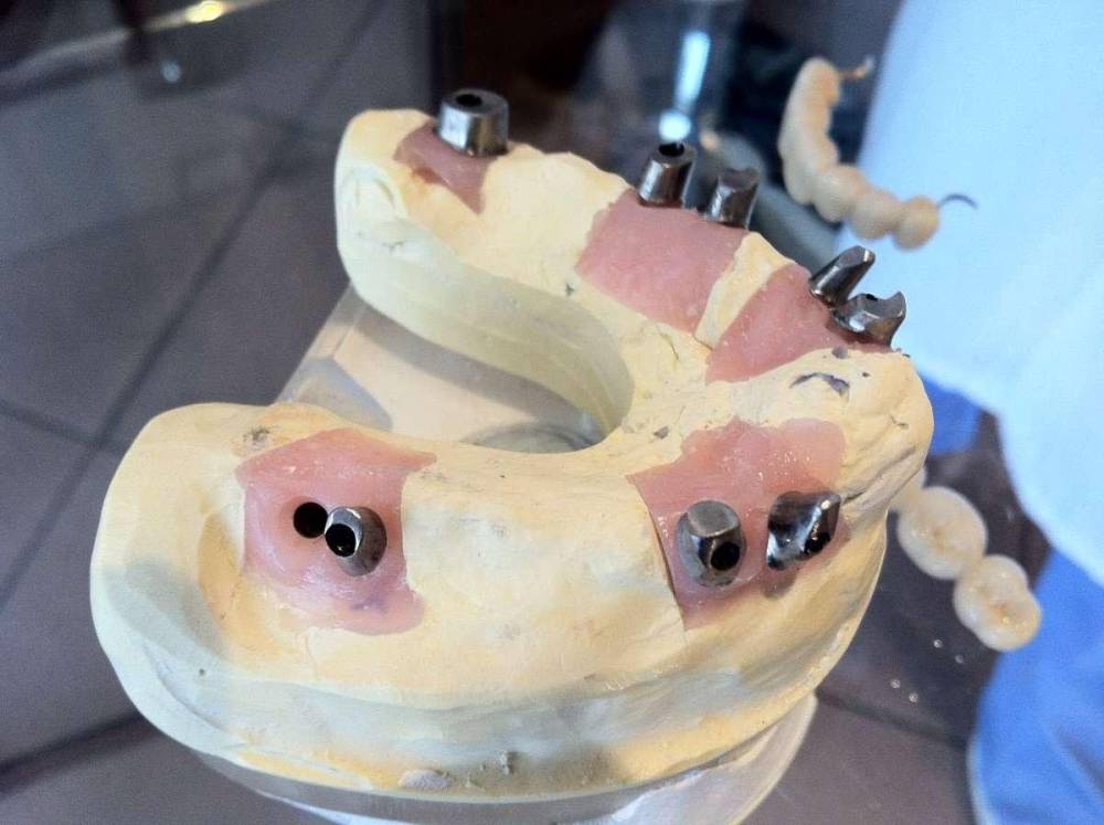 Implants dentaire à Piégut-Pluviers